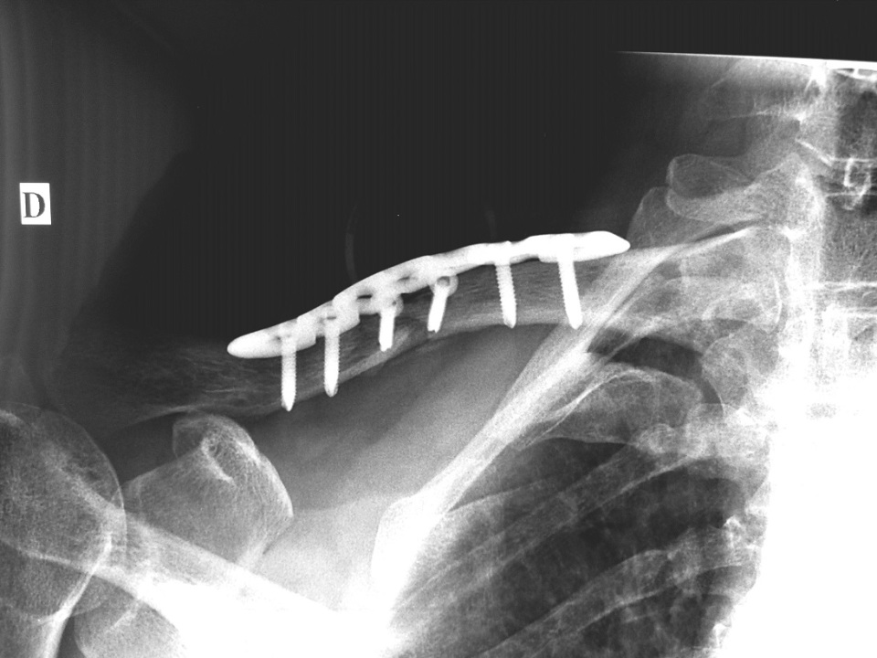 Les fractures de la clavicule Le site de l épaule