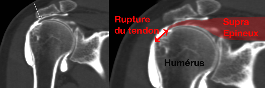 Rupture de la coiffe des rotateurs Le site de l épaule